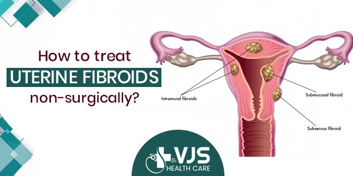 Can fibroids be treated non-surgically? Which are such treatment options?