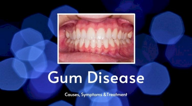 Gum Disease: Causes, Symptoms & Treatment