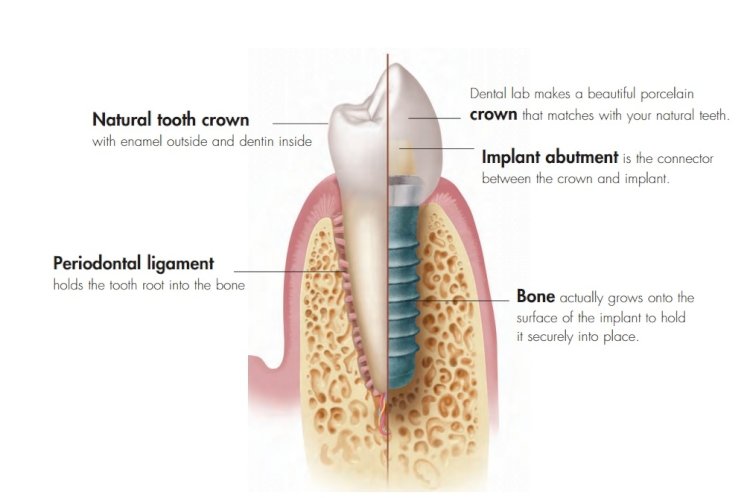 What You Need to Know Before You Go For Dental Implants